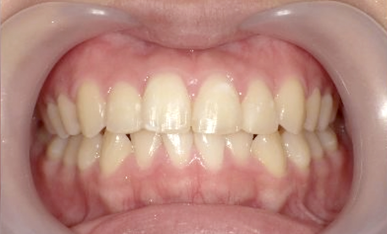 10代(18歳以上)の症例