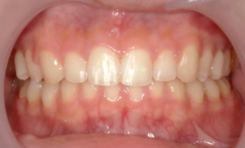 10代(18歳以上)の症例