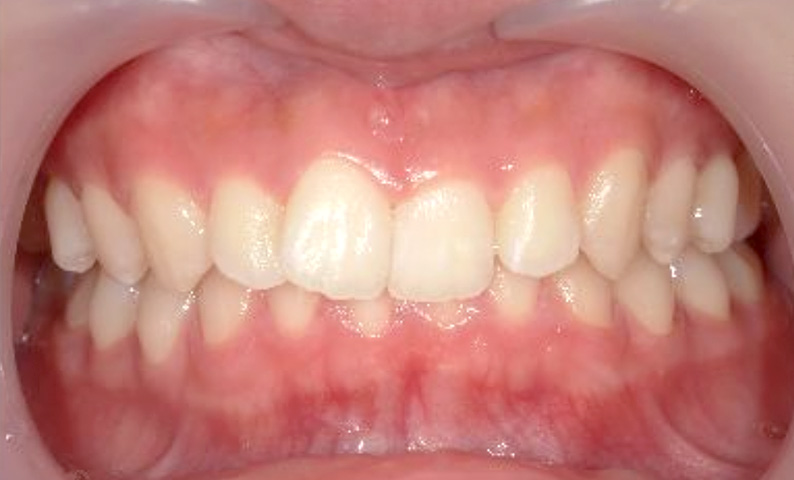 10代(18歳以上)の症例