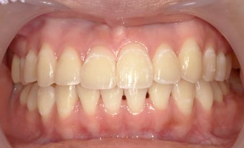 10代(18歳以上)の症例