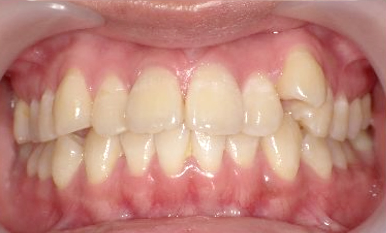 10代(18歳以上)の症例