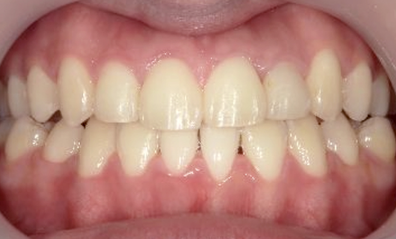 10代(18歳以上)の症例