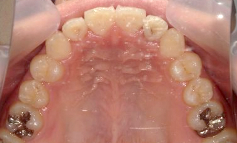 10代(18歳以上)の症例