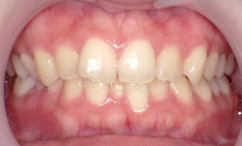 10代(18歳以上)の症例