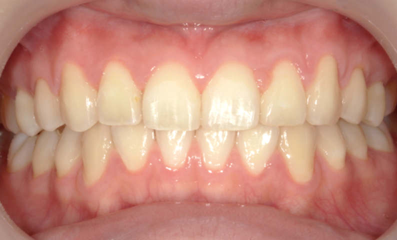 10代(18歳以上)の症例