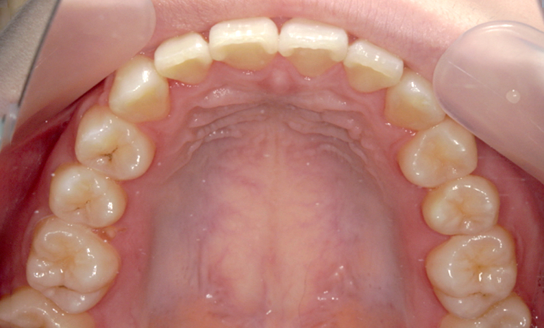 10代(18歳以上)の症例