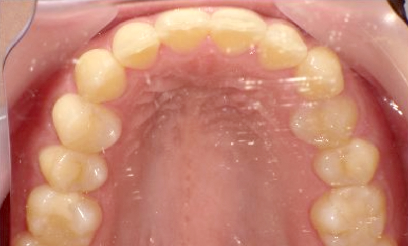 部分矯正 20代の症例写真
