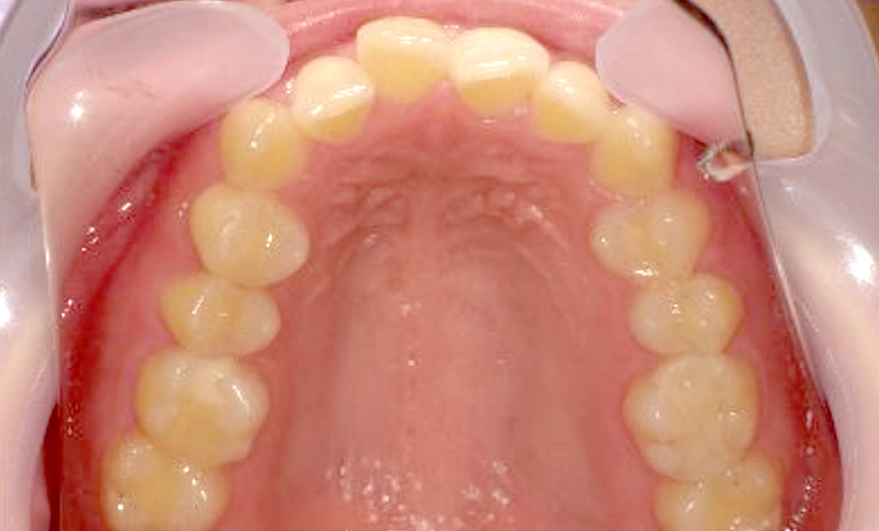 部分矯正 20代の症例写真