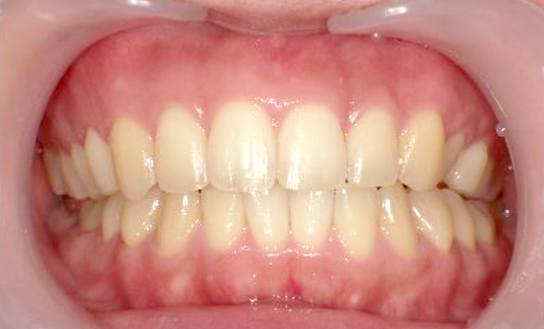 部分矯正 20代の症例写真