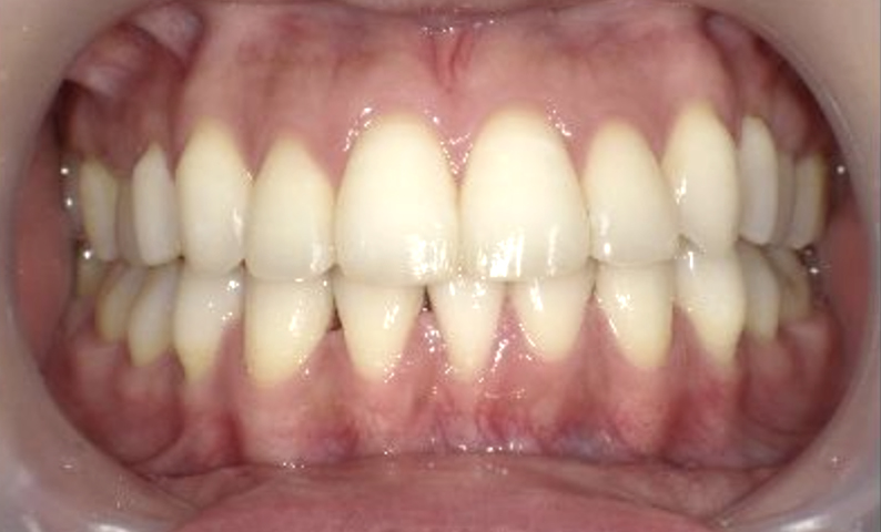 部分矯正 20代の症例写真