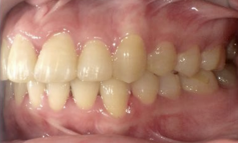 部分矯正 20代の症例写真