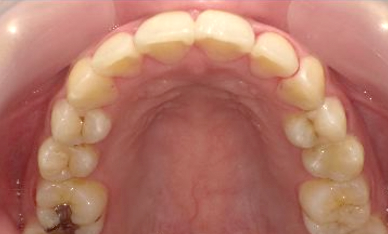 部分矯正 20代の症例写真