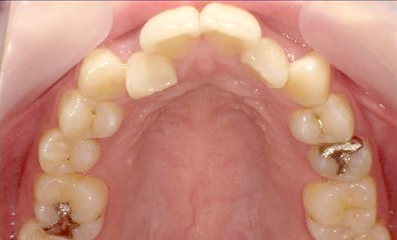 部分矯正 20代の症例写真
