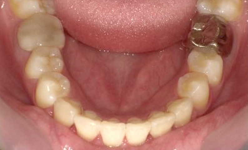 部分矯正 20代の症例写真