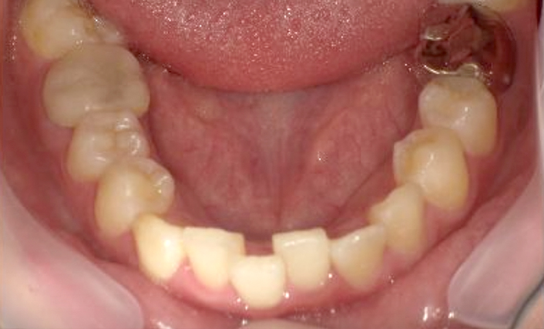 部分矯正 20代の症例写真