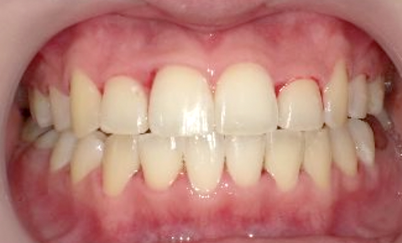 部分矯正 20代の症例写真