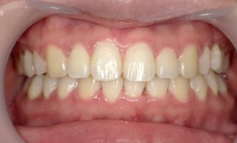 部分矯正 20代の症例写真