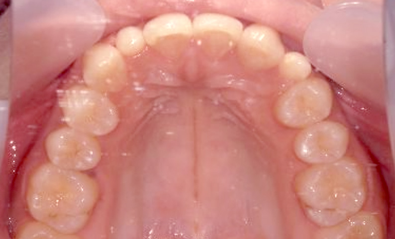 部分矯正 20代の症例写真