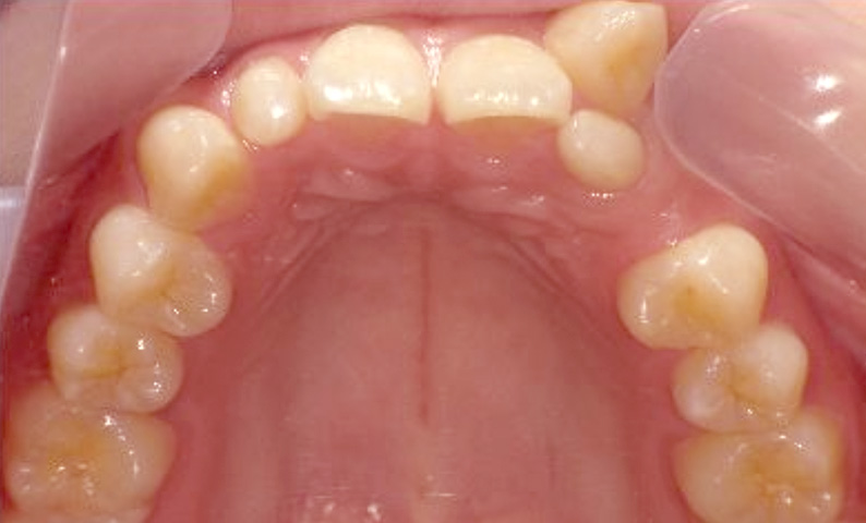 部分矯正 20代の症例写真