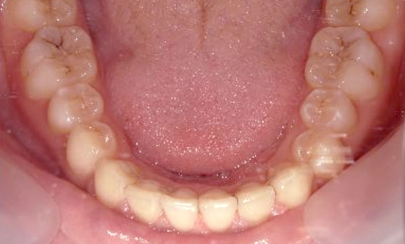 部分矯正 20代の症例写真