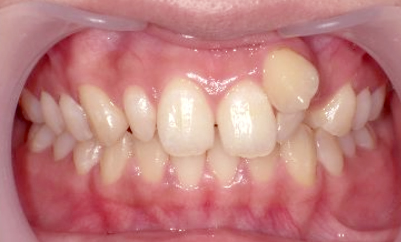 部分矯正 20代の症例写真