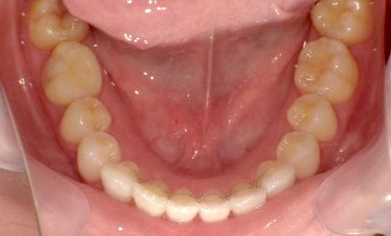 部分矯正 20代の症例写真