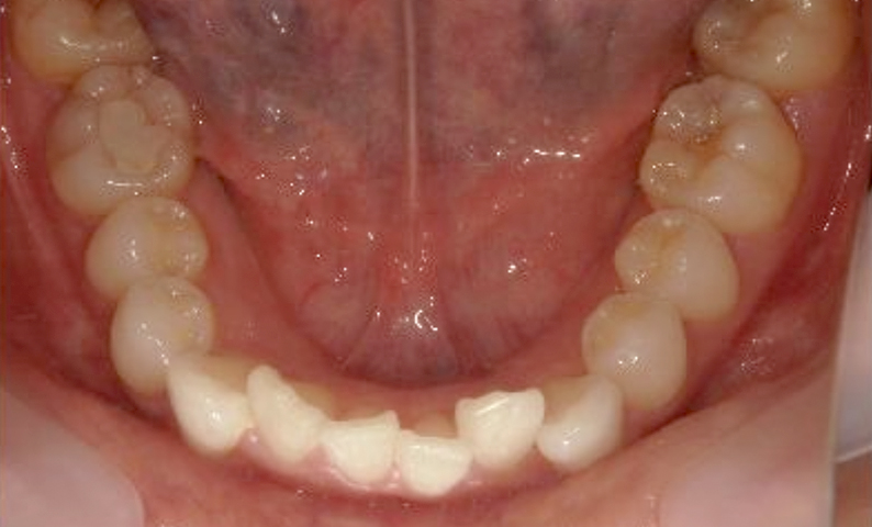 部分矯正 20代の症例写真