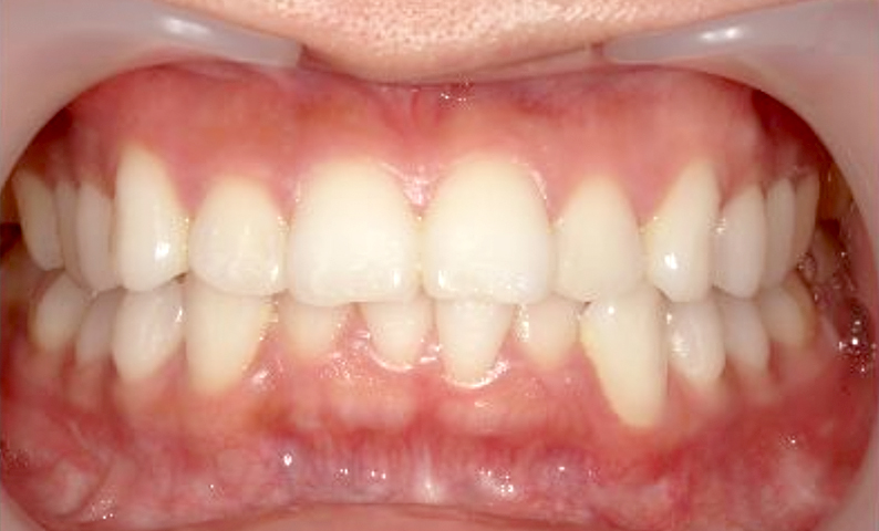 部分矯正 20代の症例写真