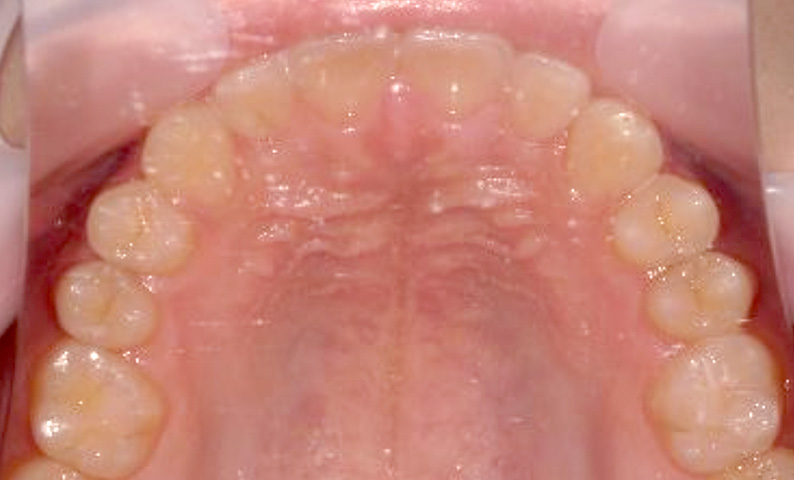 部分矯正 20代の症例写真