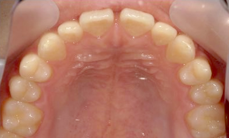 部分矯正 20代の症例写真