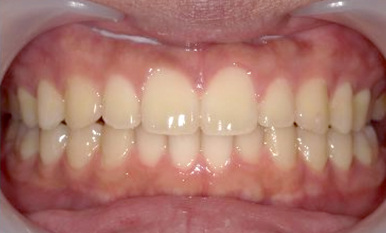 すきっ歯の症例写真