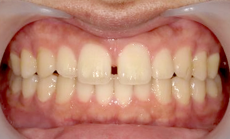 すきっ歯の症例写真