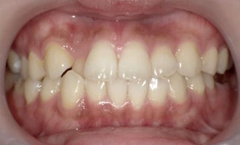 部分矯正 20代の症例写真