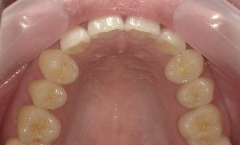 八重歯の症例写真