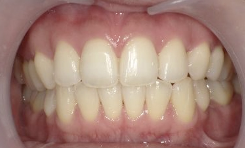 部分矯正の症例 八重歯