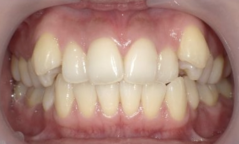 部分矯正の症例 八重歯