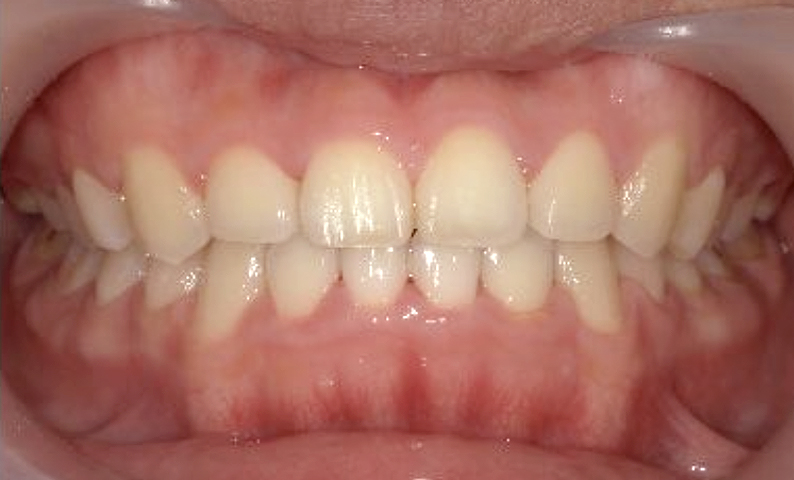 部分矯正 20代の症例写真