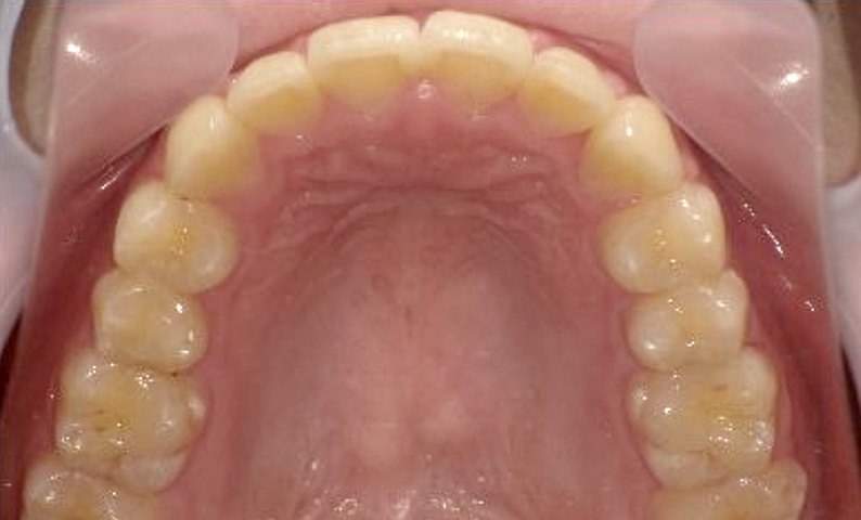部分矯正 20代の症例写真