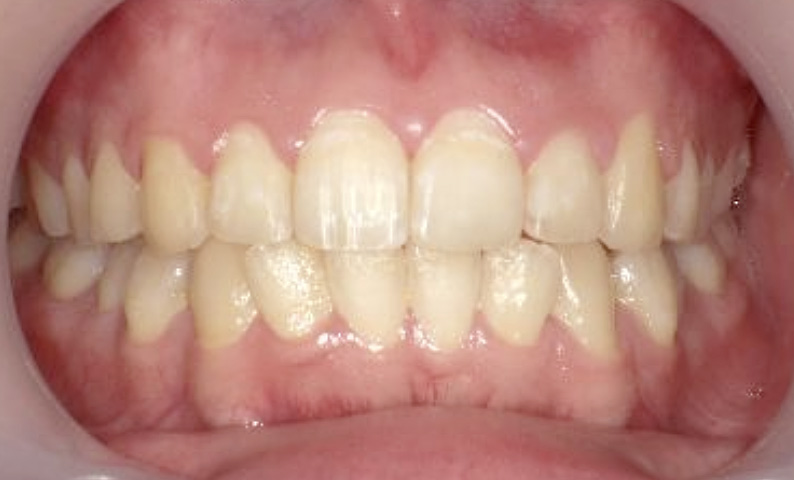 部分矯正 20代の症例写真