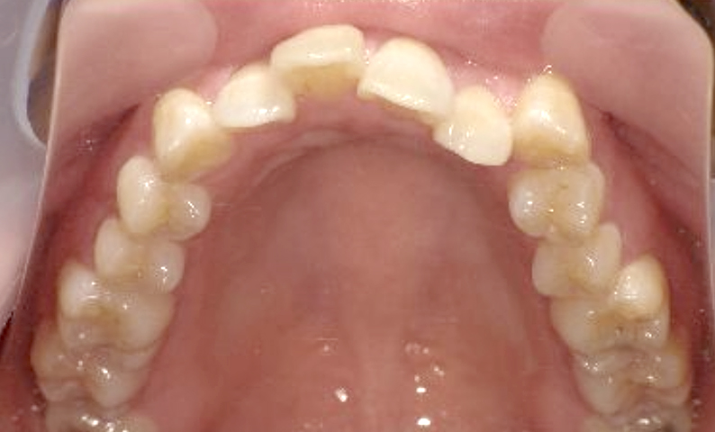 八重歯「ガチャ歯・ガタガタ歯並び」の症例写真