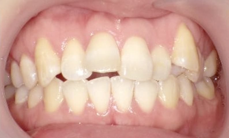 八重歯「ガチャ歯・ガタガタ歯並び」の症例写真