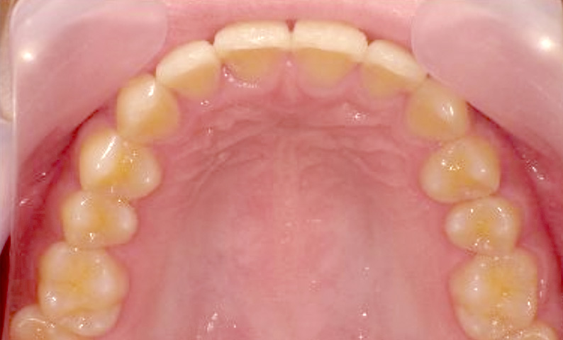 部分矯正 20代の症例写真