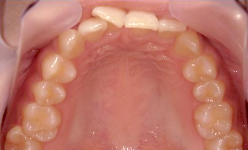 部分矯正 20代の症例写真