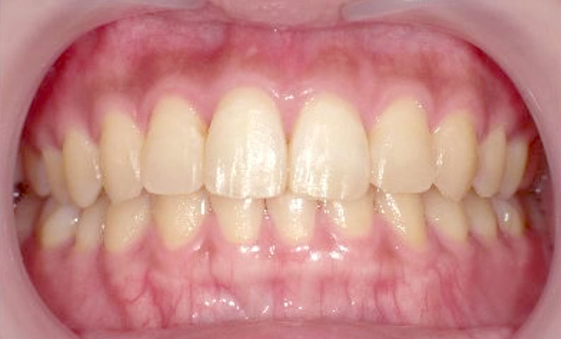 部分矯正 20代の症例写真