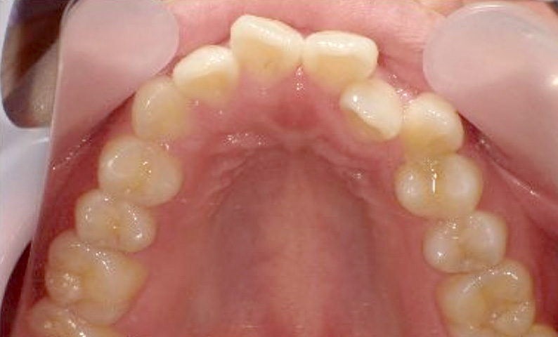 部分矯正 20代の症例写真