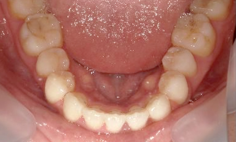 部分矯正 20代の症例写真