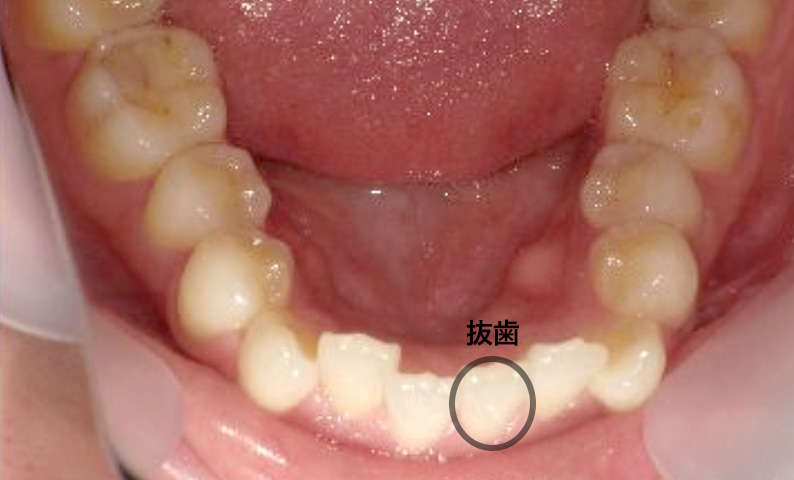 部分矯正 20代の症例写真