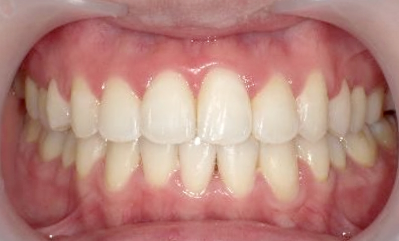 部分矯正 20代の症例写真