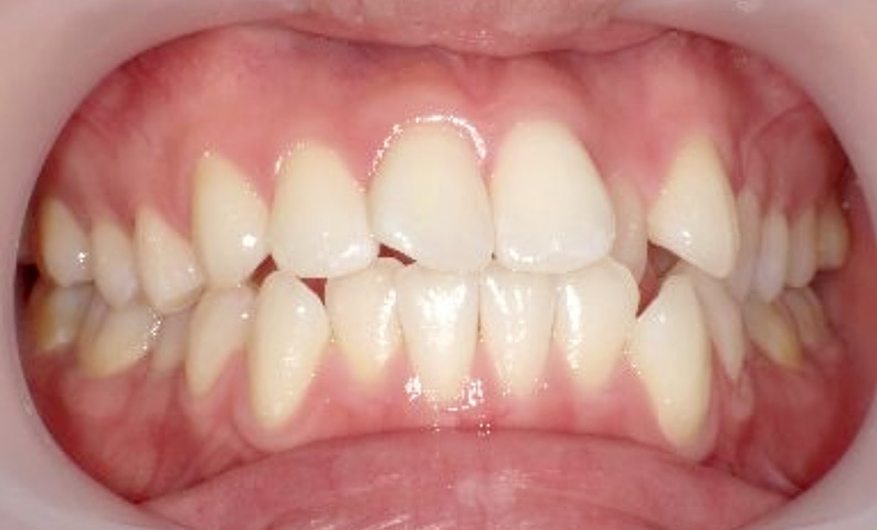 部分矯正 20代の症例写真