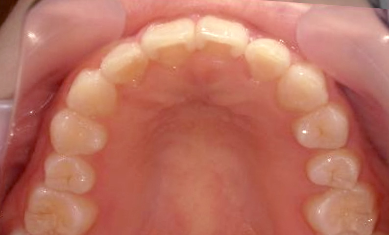 部分矯正 20代の症例写真